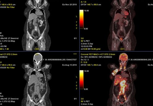 Защо се прави PET/CT сканиране?
