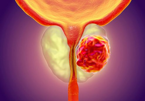 68Ga-PSMA PET-CT ДИАГНОСТИКА ЗА РАК НА ПРОСТАТА